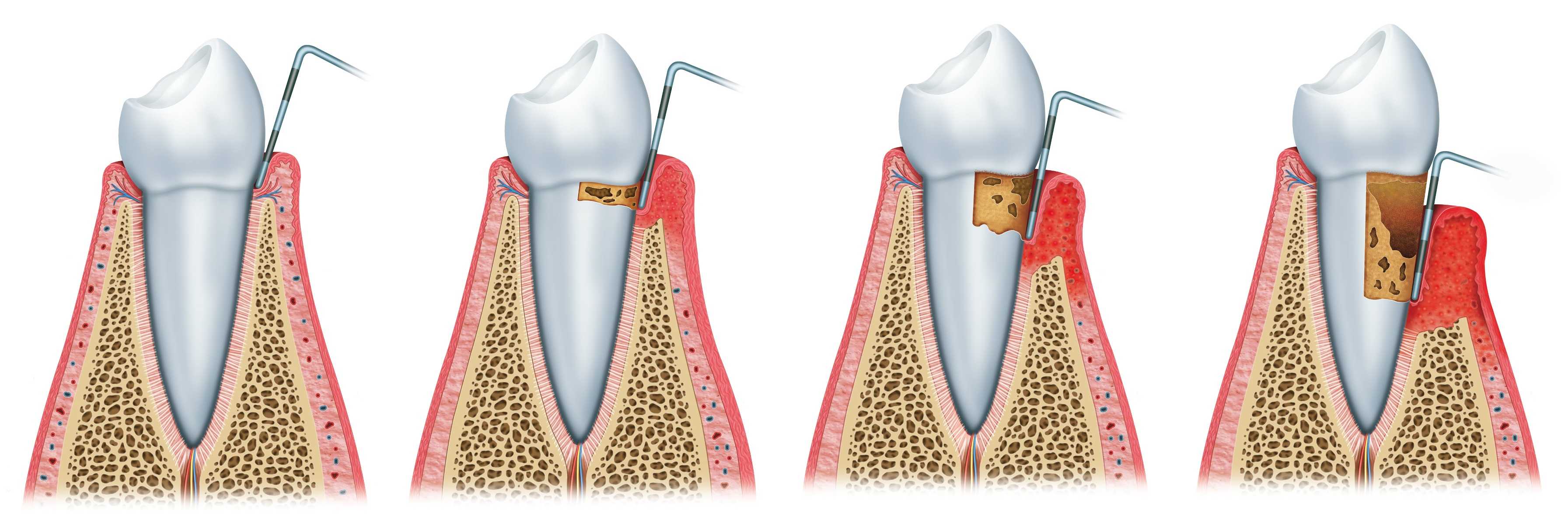 periodontzia