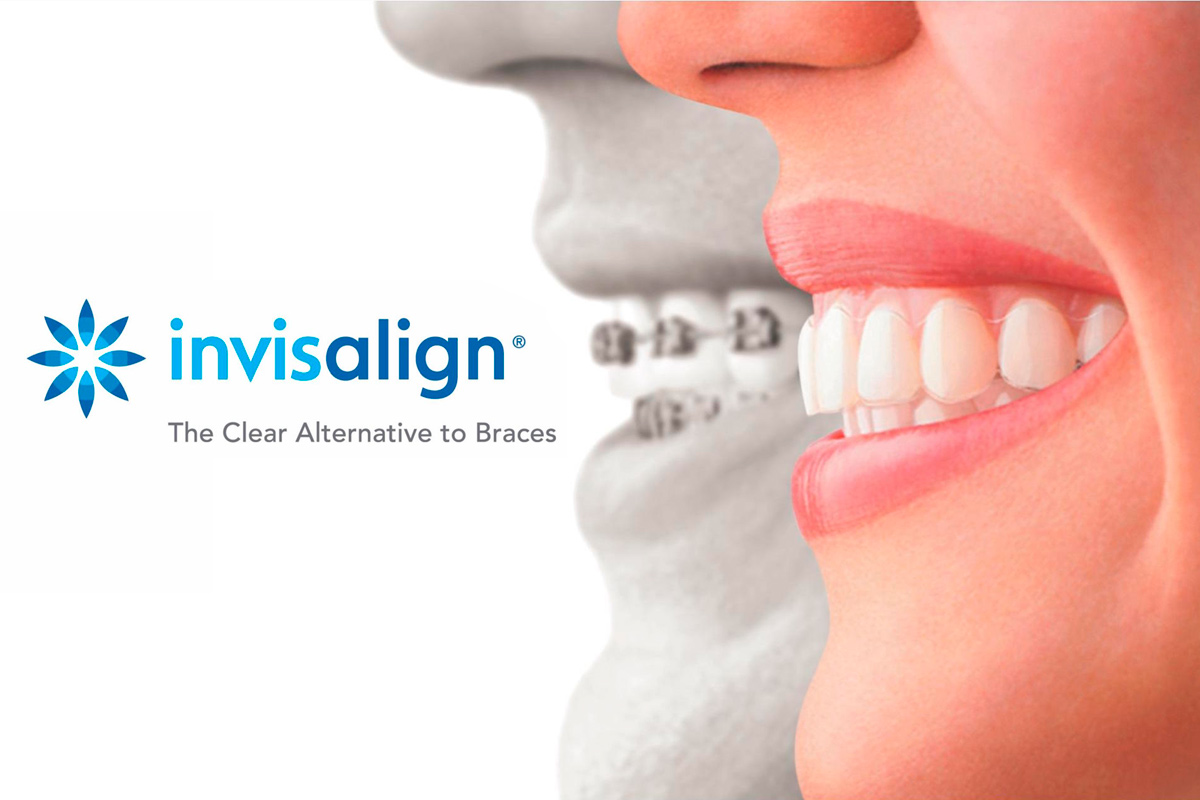 invisalign donostia- san sebastian
