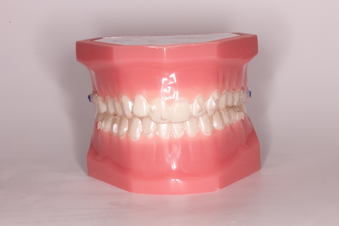aparato invisible invisalign donostia san sebastián
