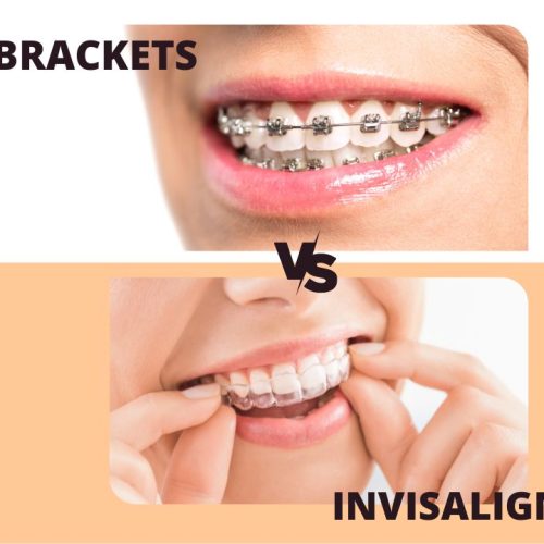 Brackets vs. Invisalign - Ainhoa Ochagavia