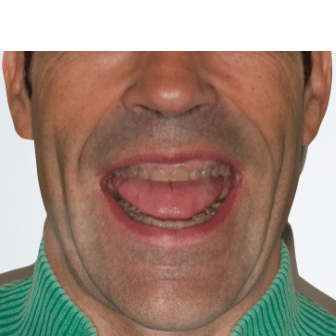 Antes Diseño Digital Sonrisa Antes Diseño Digital Sonrisa