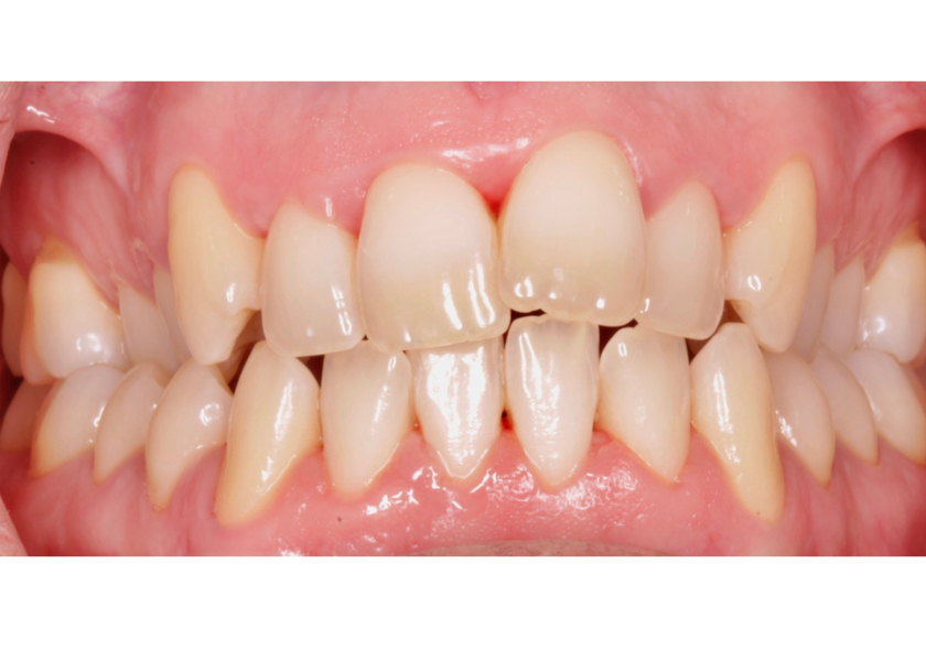 mordida cruzada mordida cruzada