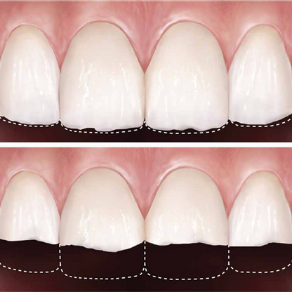 Desgaste Dental Clinica Dental Urumea