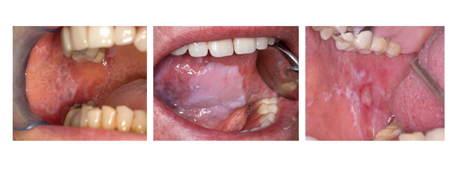 Lesiones orales bucales