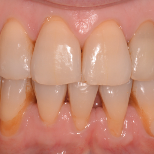 Recesion encia PUROS